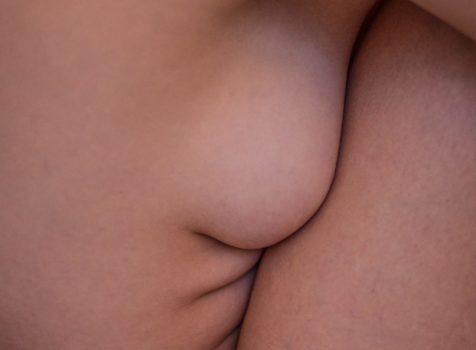 breast1